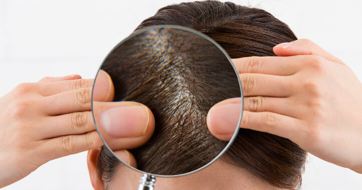 育毛剤コラム「女性の薄毛原因と育毛対策！本当に髪を生やしたいなら育毛剤はダメ？」｜イメージ画像